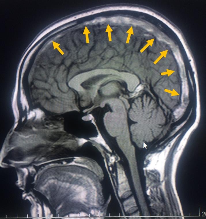 Ressonância Magnética sem contraste de um paciente internado com dor de cabeça e crise convulsiva – as setas amarelas apontam para um grande trombo no interior do seio sagital superior