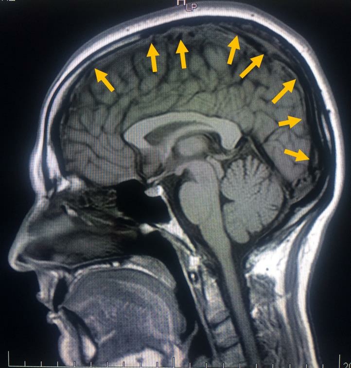 Ressonância Magnética sem contraste – mesmo paciente 6 meses após o tratamento com anticoagulante - as setas amarelas apontam para o seio sagital superior completamente livre de trombos, aqui o seio sagital superior está pret